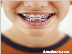 Estetik için Dişler de  Ortodonti ( Tel Tedavisi ) Yaptırmak Gusule Engel Oluyor